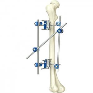 China Excellent Quality Instrument Orthopedic Tibia & Percone External Fixator Orthopedic Surgical Instruments wholesale