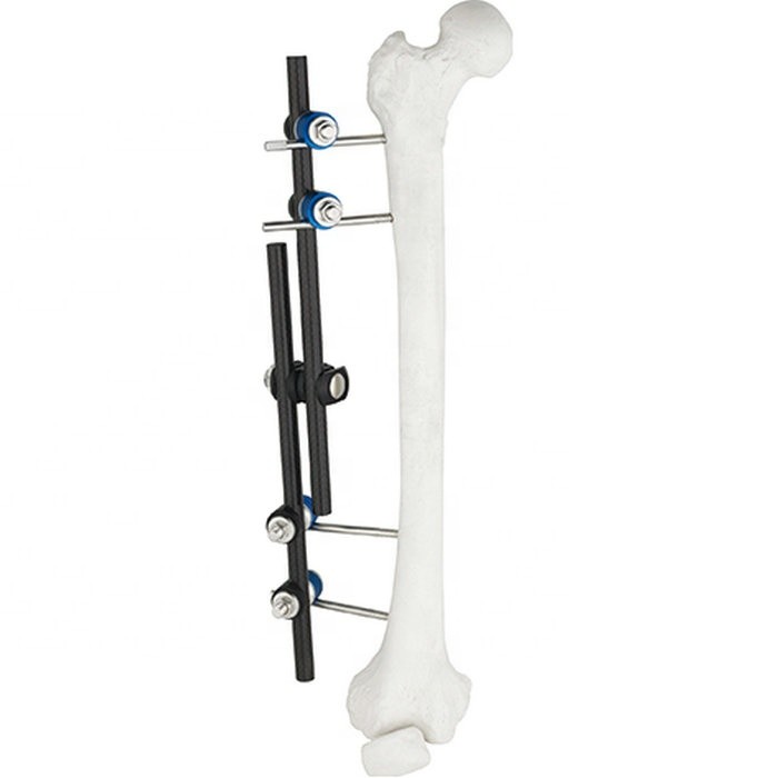 China Hot Sale Orthopedic Surgical Instruments Tibial & Femur External Fixator AO External Fixation Orthopedic Instrument wholesale