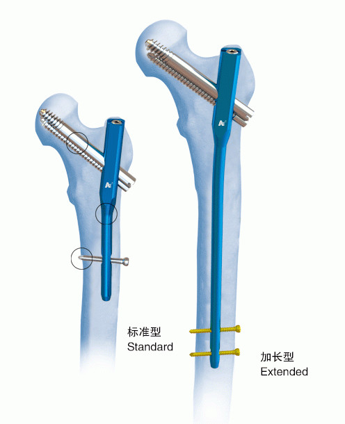 China Orthopedics Titanium Gamma Interlocking Nail Ⅳ PFN wholesale