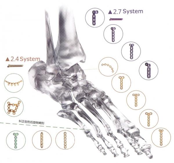 Orthopedic Implant Bone Fracture Titanium Locking Plate For Hands Foot