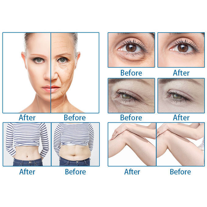 Lightweight HIFU Skin Firming Machine Customized With Adjustable 5.0 - 25mm Range