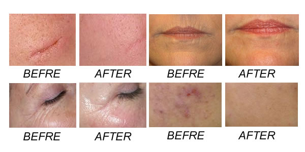 co2 fractional laser-treatment1.jpg