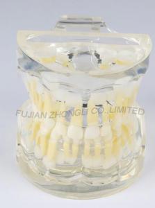 Dental Transparent Standard Model of 3 - year - old Alternative Model