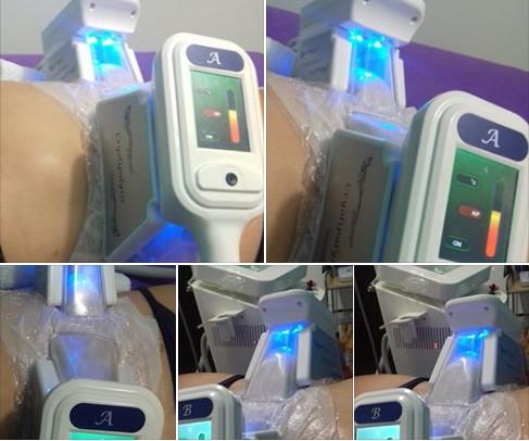 Cool body sculpting cavitation Cryotherapy Equipment Sculpsure Cryolipolysis Fat
