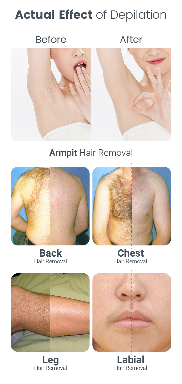 808nm / 755nm / 1064nm Diode Laser Hair Removal Machine Custom