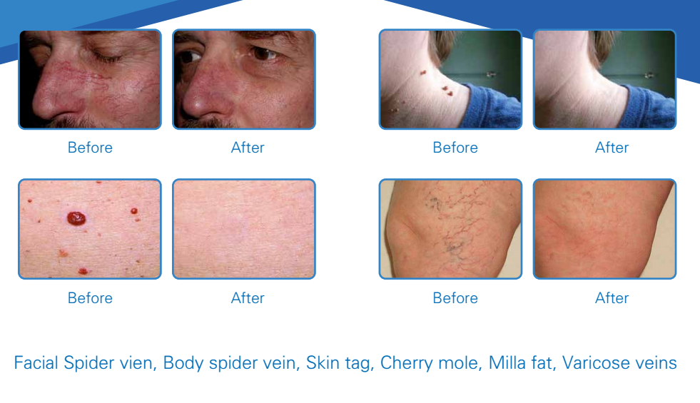 professional laser 980 medical varicose veins laser treatment machine 2018