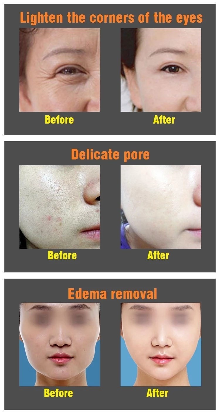 ABS Stainless Steel Wrinkle Removal RF EMS Beauty Machine